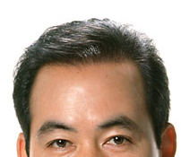 Exoderm hair implant